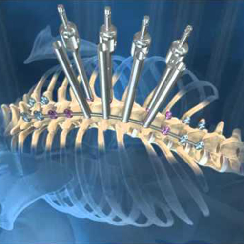 Others Spinal Implants