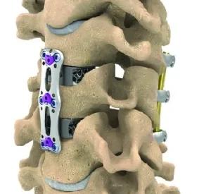 anterior-cervical-plate